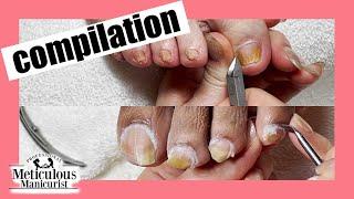 Removing the Yellow on Toenails during a pedicure