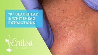 Blackhead & Whitehead Extractions on K - April 2022