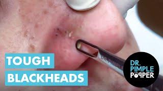 Dr Pimple Popper vs Tough Blackheads