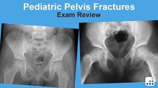 Pediatric Pelvic Fractures Exam Review - Lindsay Andras MD