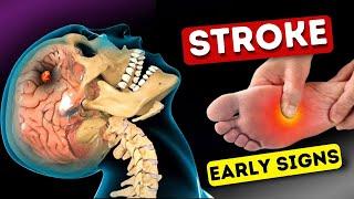 9 Warning Signs of Stroke One Month Before - Shocking Symptoms Revealed