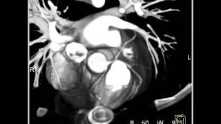 Cardiac Occluded RIMA Graft in a patient with by-pass for aberrant coronary artery 1 of 4