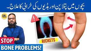 Sukha Masan Rickets Ka Ilaj  Herbal Treatment for Rickets  Dr. Ibrahim