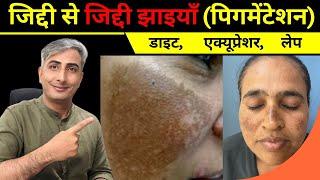 How to treat PIGMENTATION I Natural remedies for pigmentation I Melasma Treatment I DR. MANOJ DAS