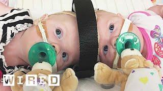 Surgeons Break Down Separating Conjoined Twins  WIRED