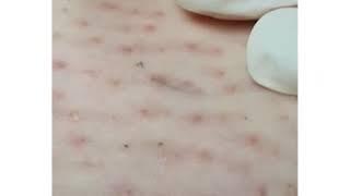 인그로운헤어 제거 Ingrown hair.