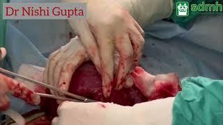 cesarean section in previous one cesarean section