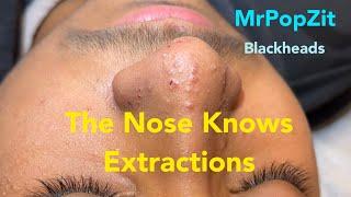 Nose extractions. Blackheads whiteheads milia.Keratin plugs extracted with deep squeeze. Pore dirt