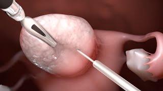 Uterine Fibroid Surgery - Robotic Myomectomy
