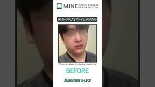 Nose and double chin surgery in 1 day #shorts #rhinoplasty