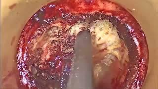 Asvide Application of transanal total mesorectal excision in natural orifice specimen extraction…