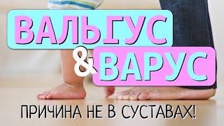 Вальгус и варус нужна ли операция?