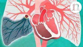 Pulmonary embolism The route to recovery