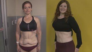 Woman Removes Loose Skin After Shedding 300 Pounds