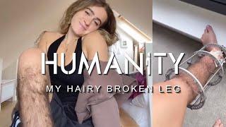 My Hairy Broken Leg  Humanity