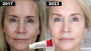 YOUNGER LOOKING SKIN AT 65?  MY 7 YEAR RETIN-A UPDATE