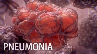 Pneumonia and the pivotal role of alveoli  medical animation