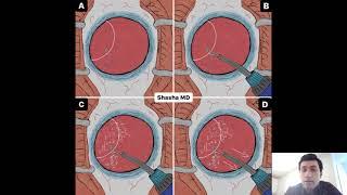 Management of a Dislocated IOL Important Consideration