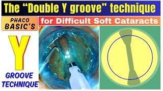 The Double Y groove technique for Difficult Soft Cataracts - Dr. Deepak Megur