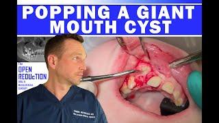 POPPING a GIANT MOUTH CYST  #cystpoping