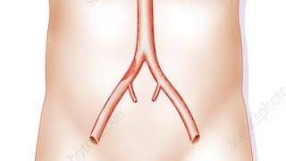 Angioplasty of Common iliac Artery