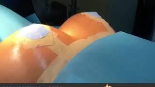 Op.Dr. Ömer Sağır - Meme Toparlama Breast Lifting