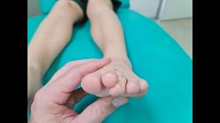 How To Treat Curly Toes In Children