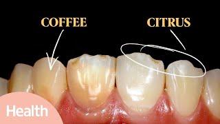 What Causes Yellow Teeth?  How to Whiten Your Teeth for a Brighter Smile  Deep Dives  Health