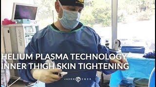 Inner Thigh Skin Tightening  RenuvionJ-Plasma  Hi-Definition Liposculpture  Thigh Lift