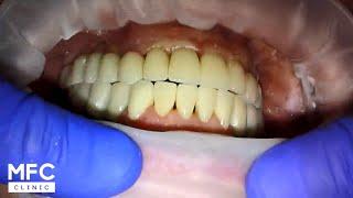 Имплантация зубов. Надеваем коронки на всю верхнюю челюсть Crowns on the upper jaw on implants上頜冠