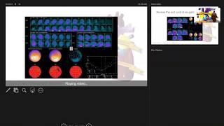 Step by Step Reading of a Cardiac SPECT Optimizing the Value of AC