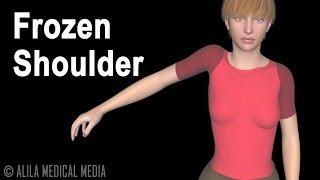 Frozen Shoulder Adhesive Capsulitis Animation.