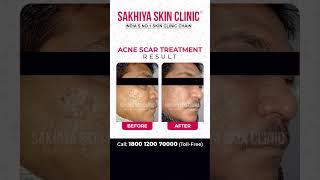 Acne Scar Treatment - Patient Success Story. #acnetreatment #clearskin #acnescars #scartreatment