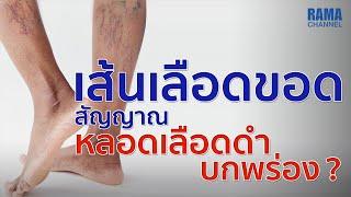 เส้นเลือดขอดสัญญาณหลอดเลือดดำบกพร่อง ?