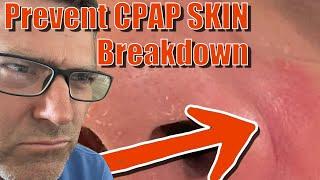 CPAP Skin Breakdown Prevent CPAP Related Dermatitis