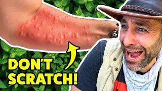 STUNG by a Costa Rican Bush