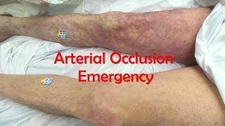 Acute Complete Occlusion of the Leg Arteries