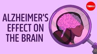 Why is Alzheimer’s disease so difficult to treat? - Krishna Sudhir