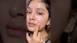 How To Get Rid Of Acne On Cheeks  Causes And Treatment For Acne  Be Beautiful #Shorts