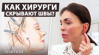 Швы после подтяжки лица Как скрываются следы операции?