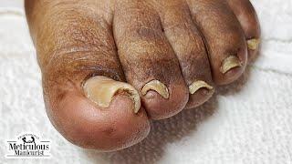 Did a Salon Make You Feel Embarrassed about Your Toenails? I can help