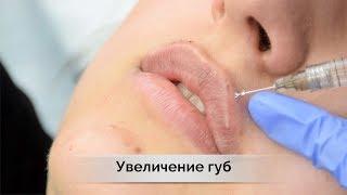 Увеличение губ или контурная пластика  филлеры  juvederm в Самаре   влог