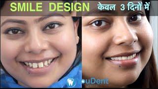 Teeth Gap Treatment in 5 Days I Zirconia Cap I Best Smile Design Dentist in INDIA  @youdent ​