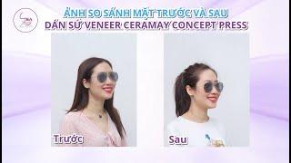 Dán Sứ Veneer Bảo Vệ Răng Gốc Thực Hiện Cùng Bác Sĩ Tại Nha Khoa Sea Dental