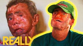 Brazilian Villagers Suffer From Rare Condition Causing Skin To ROT In The Sun  Body Bizarre