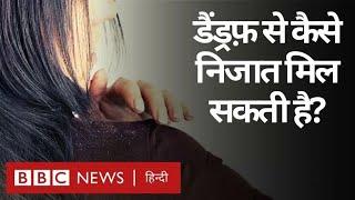 Dandruff Solutions डैंड्रफ़ की समस्या क्या बालों में रूसी का कोई इलाज है? BBC Hindi