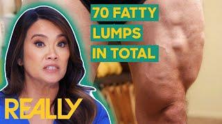 Dr. Lee Removes 27 Lipomas From A Patients Body  Dr. Pimple Popper