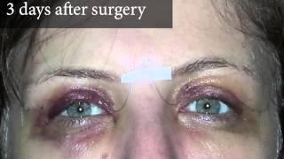 Upper Eyelid Surgery - After Photos 3 Days Post Surgery  8 West Clinic in Vancouver BC