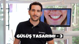 Gülüş Tasarımı Nasıl Yapılır? Vaka İnceleme