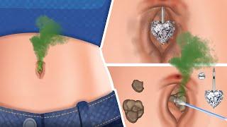 ASMR How to best treatment and clean navel piercings navel stones  현실적인 케어 트리트먼트 애니메이션 2023
